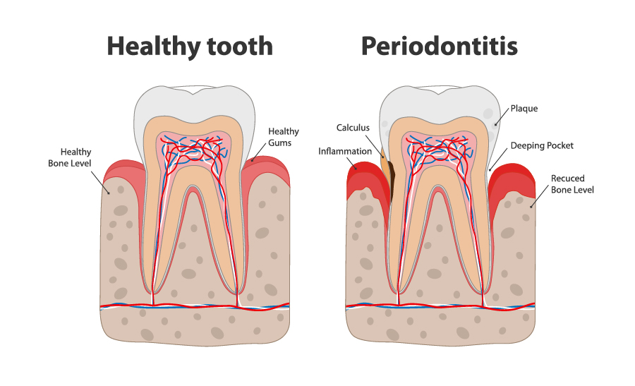 Root Canal in Peoria